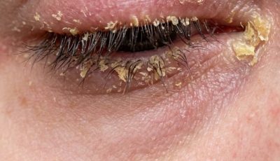 My eyelids feel sticky and irritated when I wake up every morning. What causes this?.