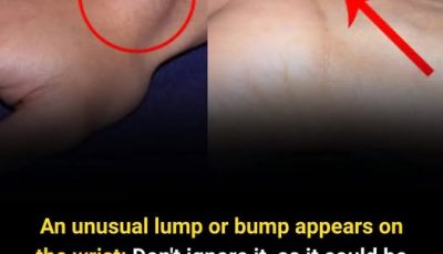  Notice an Unusual Lump on Your Wrist? Here’s What It Could Mean