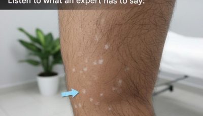 Why do white spots appear on the skin?