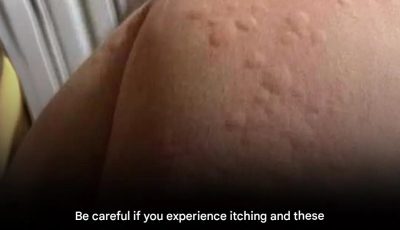 Be careful if your body is itchy and these bumps appear on your skin…
