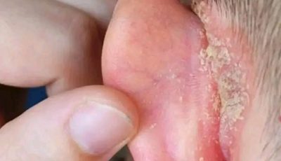 Common Causes of a Spot on the Ear