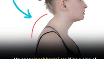 The Hidden Health Warning Behind a Neck Hump — Plus 5 Steps That May Help